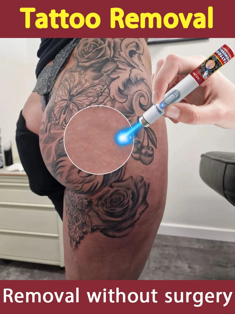 Nᴀɴᴏ ʟᴀsᴇʀ ᴘᴇɴ ʀᴇᴍᴏᴠᴇs ᴛᴀᴛᴛᴏᴏs ᴏғ ᴀʟʟ sɪᴢᴇs ᴘᴀɪɴʟᴇssʟʏ ᴀɴᴅ ᴡɪᴛʜᴏᴜᴛ sɪᴅᴇ ᴇғ